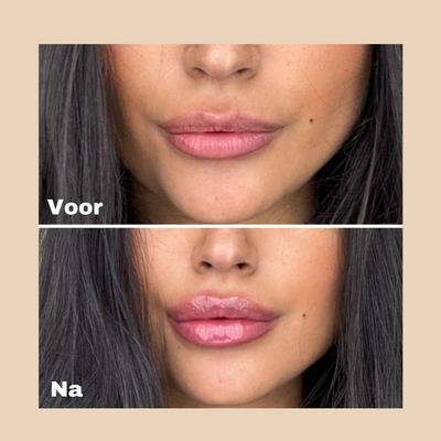Extreme Lip Plumper
